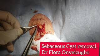 A huge sebaceous cyst removal from the face. Dr Flora Onyeizugbo