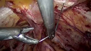 Asvide: This video provides a step-by-step guide on how to do a laparoscopic Burch colposuspension…