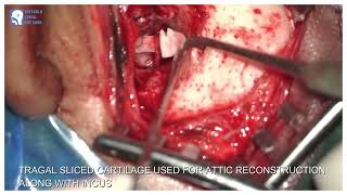 CARTILAGE BOOMERANG OSSICULOPLASTY AS TOTAL OSSICULAR REPLACEMENT BY DR RVINDRA BANSAL