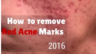 How to remove red marks from acne