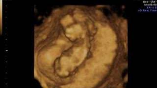 12w6d 3D ultrasound