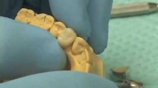 Fabricating Provisional Crowns