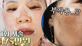 1회에 175만원 슈퍼 FLEX 레이저 시술! 그런데...?