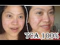 DIY 100% TCA Cross at home(3rd Session) Acne Scar Treatment/BelleLife Tv