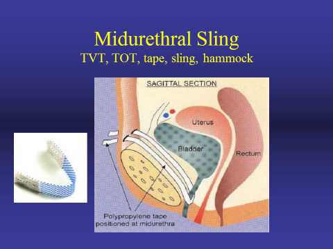 Stress Urinary Incontinence Evaluation and Treatment Stress Urinary Incontinence Evaluation and Treatment