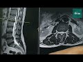 how does a slip disc look in mri best slip disc doctor india microscopic slip disc drhiteshgarg