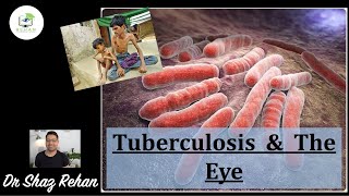 TB and The Eye: Can TB Affect the Eyes? I Dr Shaz Rehan, 2021