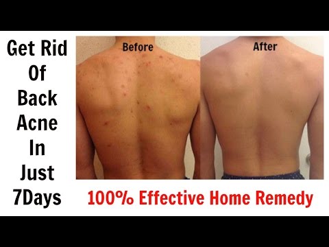 Get Rid Of Back Acne In Just 7 Days || 100% Effective Home Remedy Get Rid Of Back Acne In Just 7 Days || 100% Effective Home Remedy