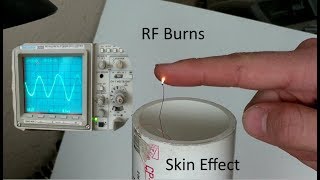 RF Burns and the Skin Effect