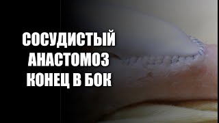 СОСУДИСТЫЙ АНАСТОМОЗ КОНЕЦ В БОК (ПАРАШЮТНАЯ ТЕХНИКА) / VASCULAR ANASTOMOSIS (PARACHUTE TECHNIQUE)