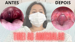 TIREI AS AMÍGDALAS! VLOG AMIGDALECTOMIA | thaysa suelen