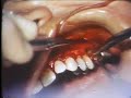 surgical elimination of periodontal pockets