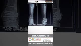 Comminuted Distal femur fracture with intra-articular extension