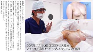 【症例動画】豊胸トップドクターが解説！20代女性・アキーセル併用コールマン式コンデンスリッチ豊胸【湘南美容クリニック】【新宿本院院長 中村大輔】