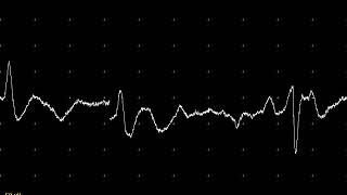 EMG teaching video 4: Fasciculation potentials in the tongue