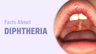 Facts about Diphtheria | Diseases Decoded | NEET SS 2.0