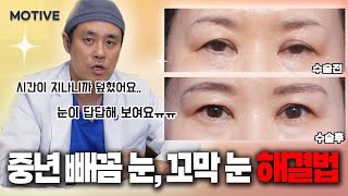 빼꼼눈 꼬막눈 아줌마 쌍꺼풀 해결하는 방법 + 전후사진 리뷰 #중년눈성형