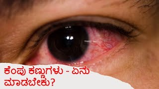 ಕಂಜಂಕ್ಟಿವೈಟೀಸ್, ಕೆಂಪು ಕಣ್ಣು: ಲಕ್ಷಣಗಳು, ಕಾರಣಗಳು ಮತ್ತು ಚಿಕಿತ್ಸೆ : Dr Rashmi G