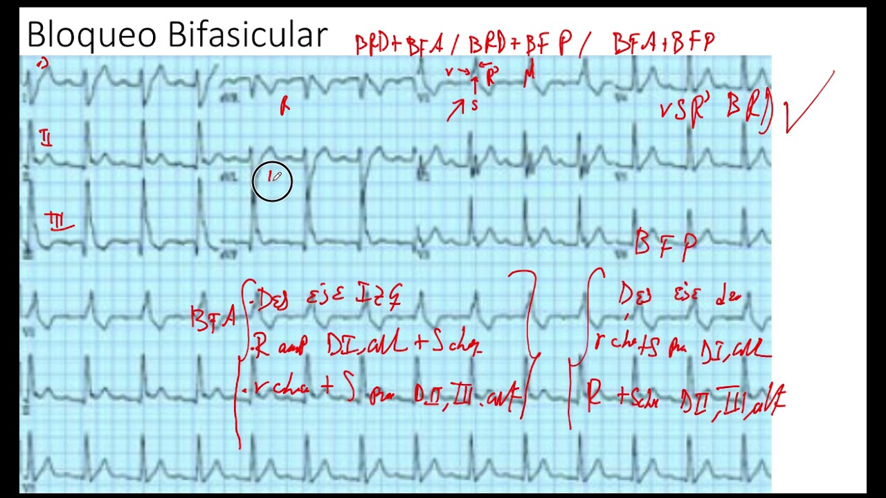 Ejemplo Bloqueo Bifascicular - YouTube