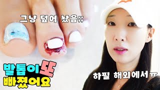 실제상황! 해외에서 발톱이 또 빠졌습니다ㅠ 이번엔 피가 너무 많이 나요! 가족 일상 브이로그 vlogㅣ토깽이네