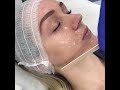 Forma - Radiofrequency Skin Tightening Treatment