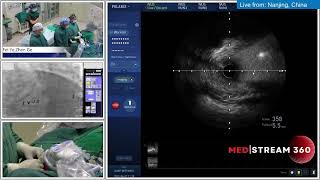 IVUS-Guided PCI Of LM Trifurcation Using IABP Support + RA