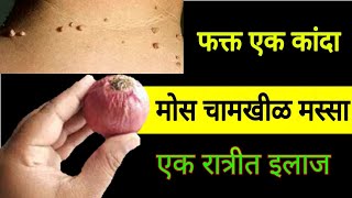 एक कांदा आणि चामखीळ मोस मस्सा गायब । chamkhilvar gharguti upay