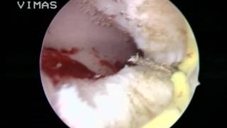 HYSTEROSCOPIC RESECTION OF A COMPLETE UTERINE SEPTUM