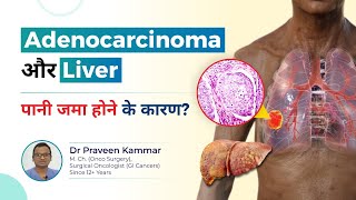 Adenocarcinoma और Liver: पानी जमा होने के कारण? | Fluid Buildup in the Liver | Dr Praveen Kammar