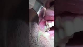 HUGE dental infection and abscess PUS drainage shorts