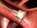 Edwards Sapien Transcatheter Heart Valve