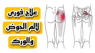 علاج عرق النسا الكاذب |علاج فورى لالم الحوض |متلازمة العضلة الكمثرية