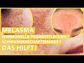 MELASMA Behandlung – So wirst Du die Pigmentflecken im Gesicht endlich los