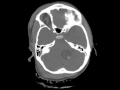 CT Head Trauma temporal bone fracture DISCUSSION by Radiologist