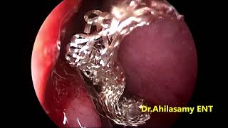 Spontaneous Cribriform CSF Leak - Dr. Ahila's Technique of closure - No postop pack