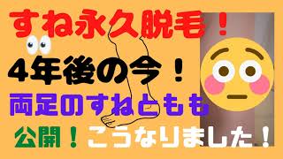 すね毛医療（永久）脱毛！4年後の今は!？どうなった？？【医療脱毛アレクサンドライトレーザー】Medical hair removal effect　Shin hair removal