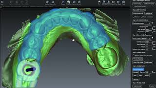 Posterior Edentulous Implant Surgical Guide Design:  Tips and Tricks in Planmeca Romexis