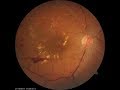 Treatment for Retinal Vein Occlusion