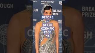 Before After Ozempic Face