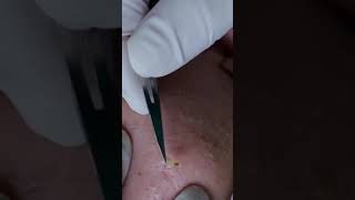 ASMR | Satisfying Blackheads/Whiteheads Removal