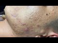 Relax with Linh My Dang - The big pimples of Mr.  Thai Part 2 #byMyAnhDang 06