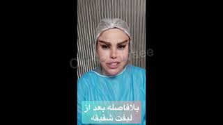 بلافاصله بعد از لیفت ابرو و لیفت شقیقه #لیفت_صورت  #جراحی_زیبایی #لیفت #لیفتینگ لیفتینگ #لیفت_ابرو