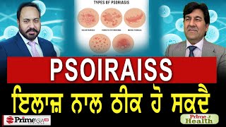 Psoriasis, It can be cured with treatment  || Prime Health (102)