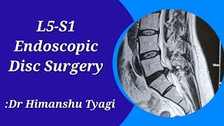 L5-S1 Endoscopic Disc Surgery (Slip disc operation/herniation/Disc prolapse/extrusion/Sequestration)