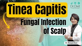 Fungal infection in hair scalp treatment | Tinea capitis scalp |fungal infection treatment,bangalore