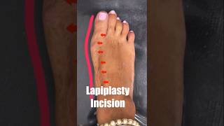 Lapiplasty™ vs MIS bunion Surgery #shorts