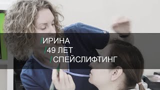 Спейслифтинг. Путь к совершенству. История пациента