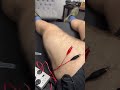 dry needling an incredible treatment we use as a small part of our rehab u0026 sports performance 🪡