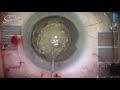 Femtosecond Laser Cataract Surgery with CATALYS Laser System Real Live Surgery Demonstration