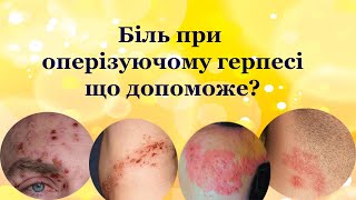 Оперізуючий герпес народна і офіційна медицина : хто ефективніший ? В який момент?